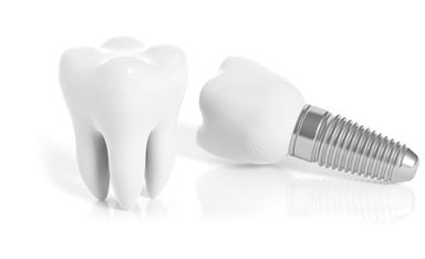 Dental Implants