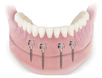 Mini Dental Implants